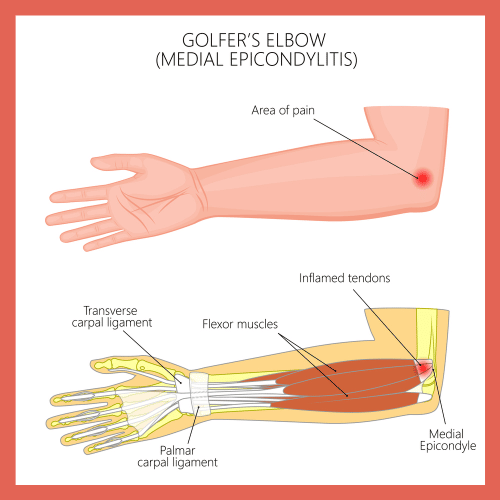 golfer's elbow anatomy and area of pain shown by coach todd