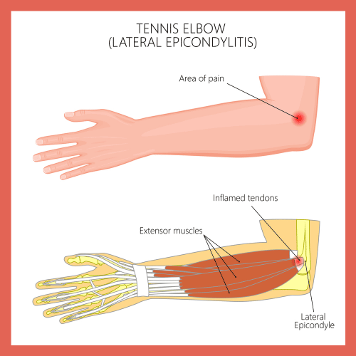 tennis elbow anatomy