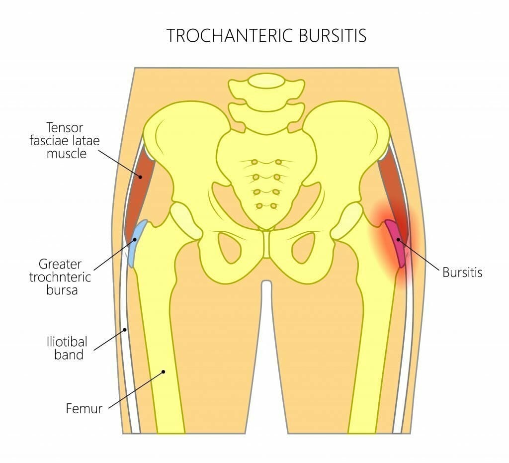 exercising with hip bursitis