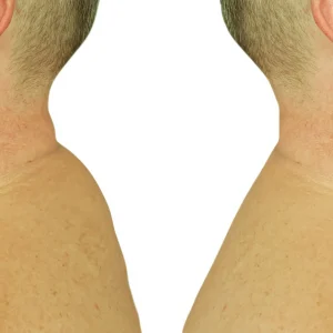 Neck Hump scaled