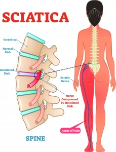 Sciatica Nerve Pain due to Pinched Nerve