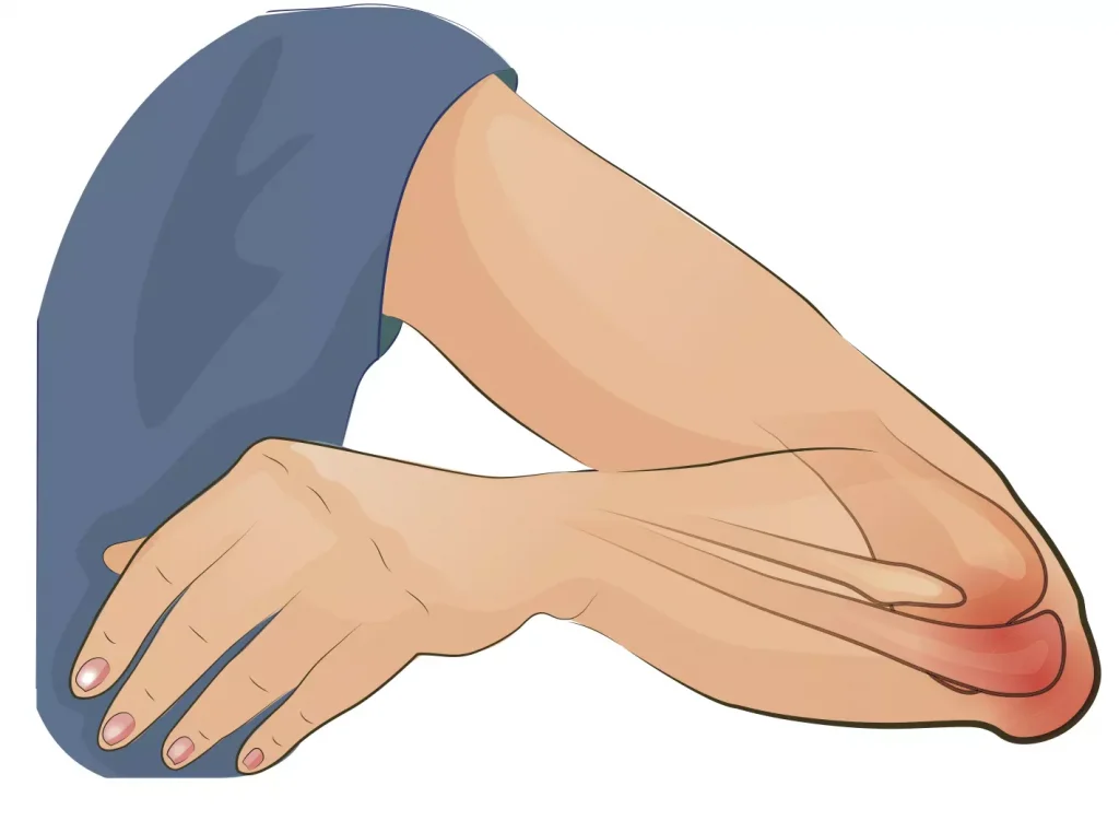 Pain due to elbow Bursitis