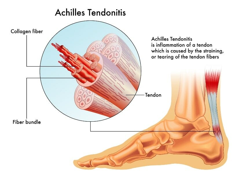 achilles tendonitis anatomy