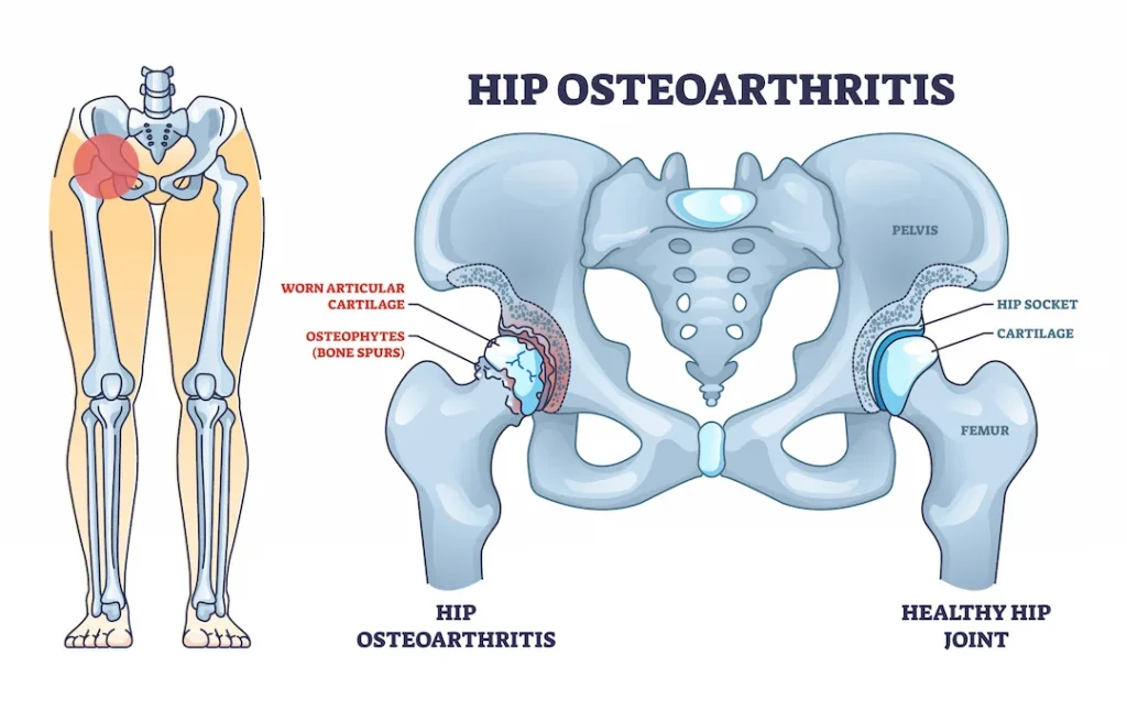 Hip osteoarthritis is number on cause for hip replacement