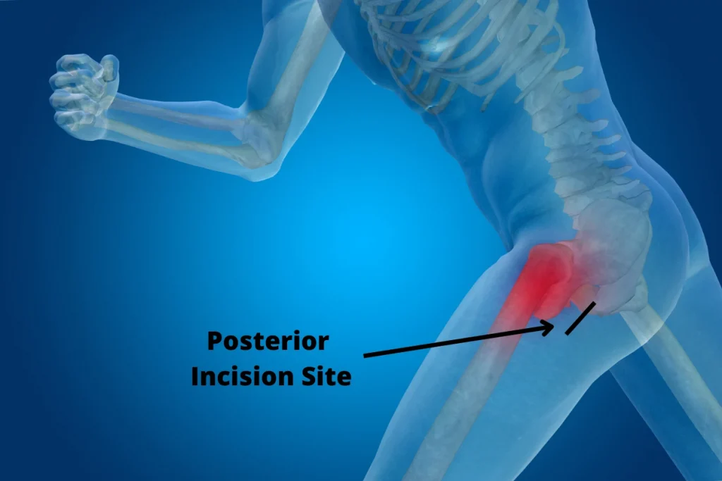 Posterior hip replacement incision site