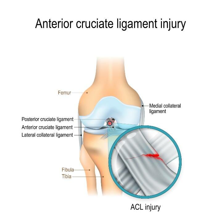 Anterior cruciate ligament injury aka ACL anatomy