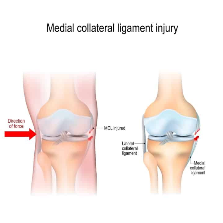 MCL Tear or medial collateral ligament injury anatomy