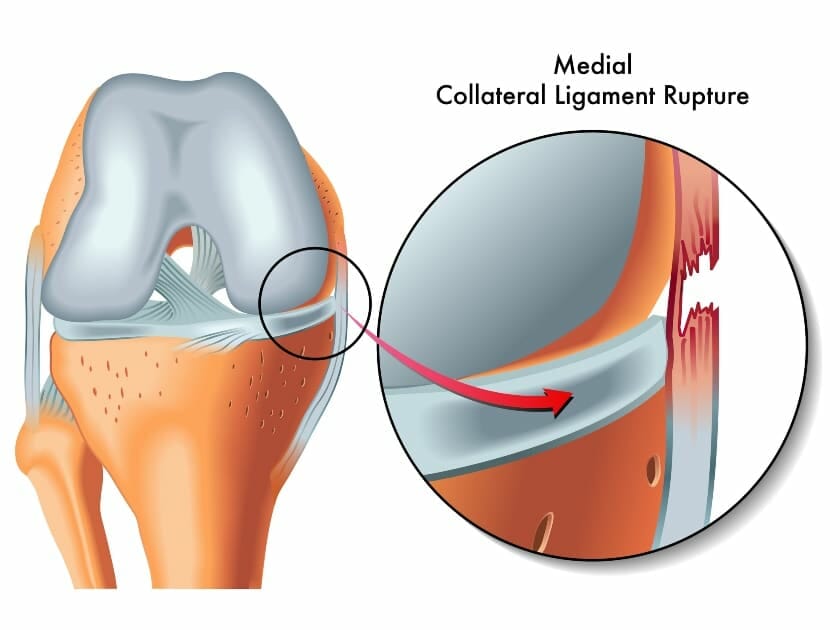 Medial collateral ligament rupture anatomy