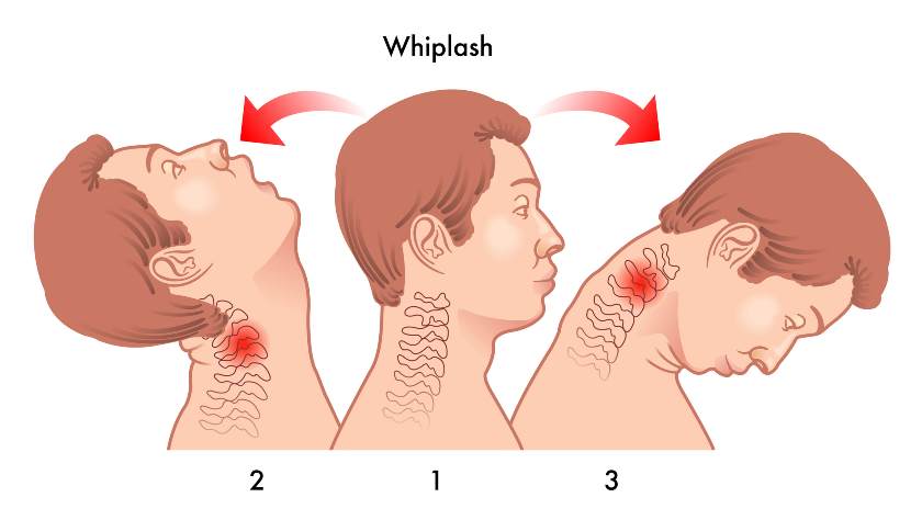 Whiplash injury anatomy