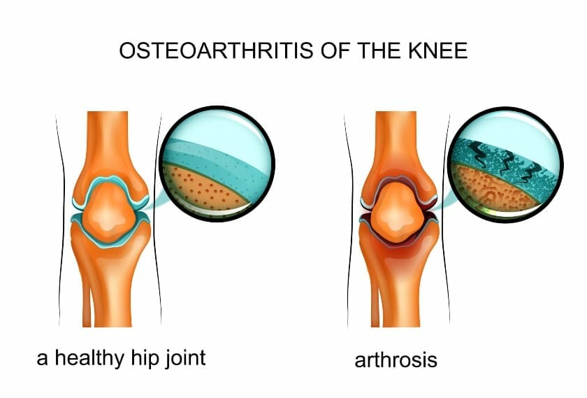 Image showing a healthy hip joint and arthrosis due to Osteoarthritis of the knee