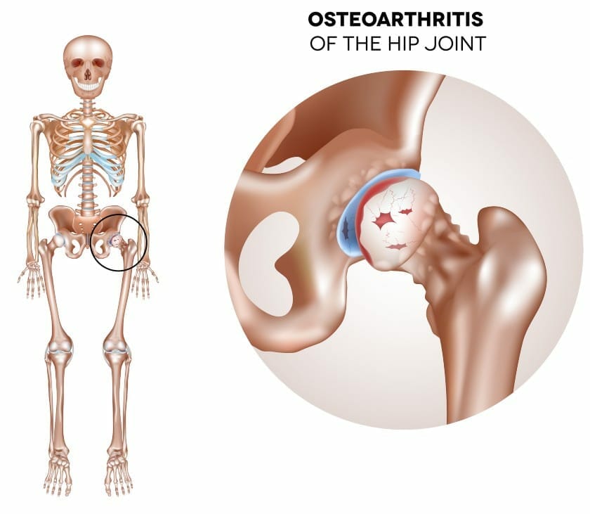 Hip Osteoarthritis