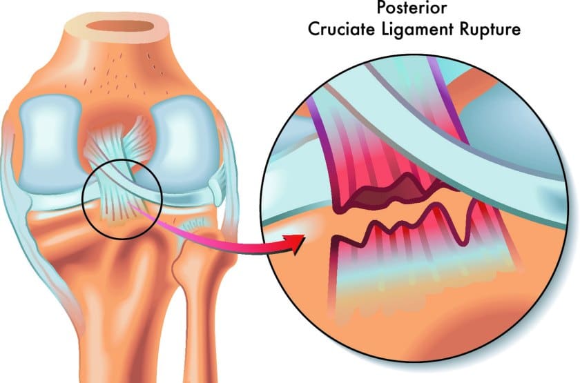 posterior cruciate ligament injury