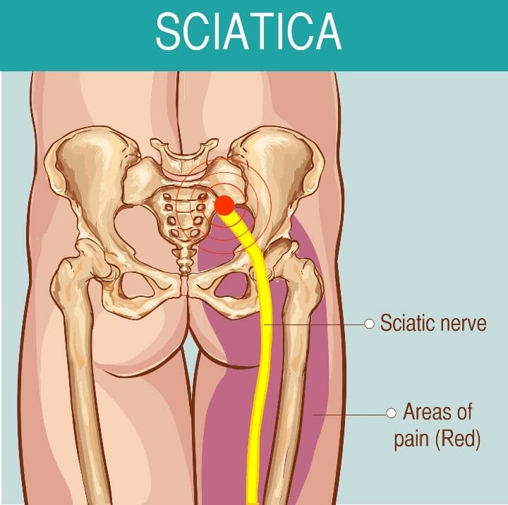 Sciatic nerve picture