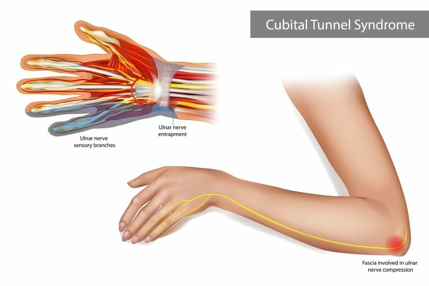cubital tunnel syndrome associated with ulnar nerve entrapment