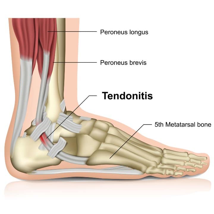 foot tendonitis is another cause of foot pain in the morning
