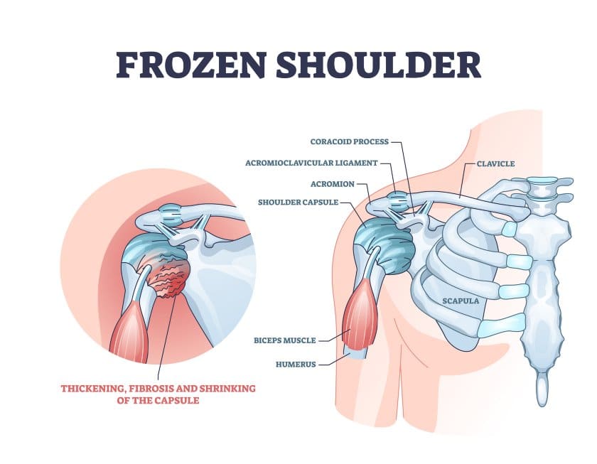  Frozen Shoulder