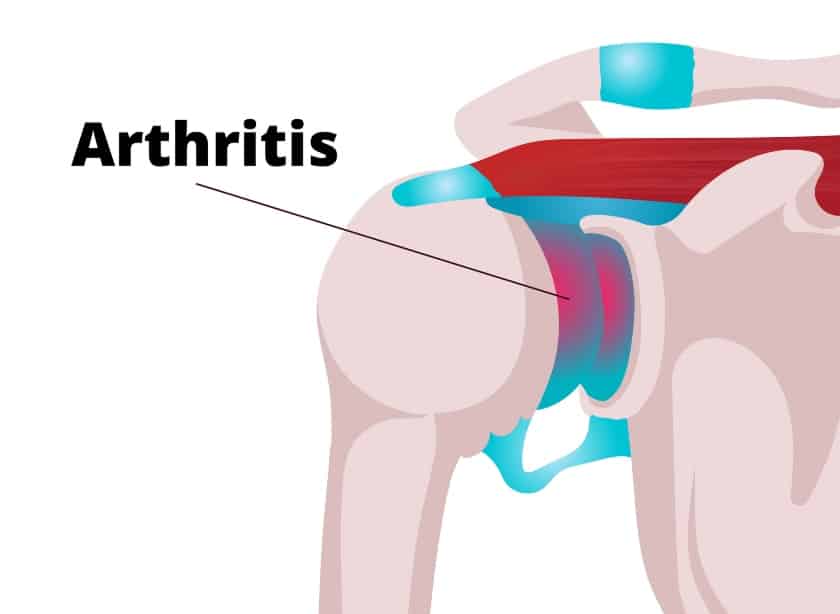 cause of shoulder popping: arthritis