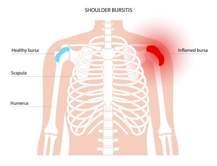 Shoulder bursitis
