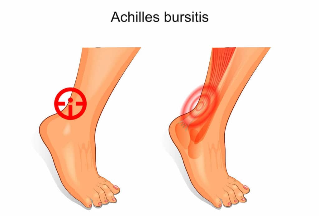 Achilles Bursitis