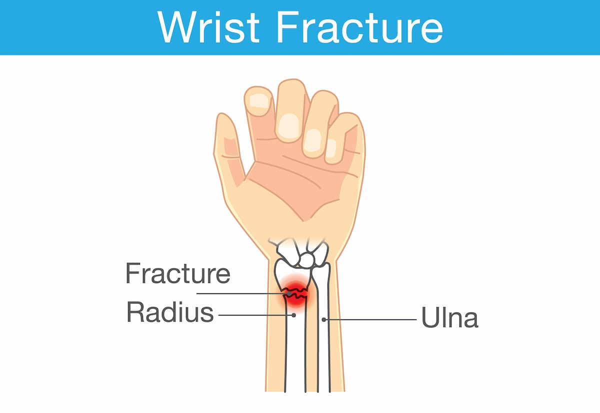 Wrist Fracture Rehab Exercise