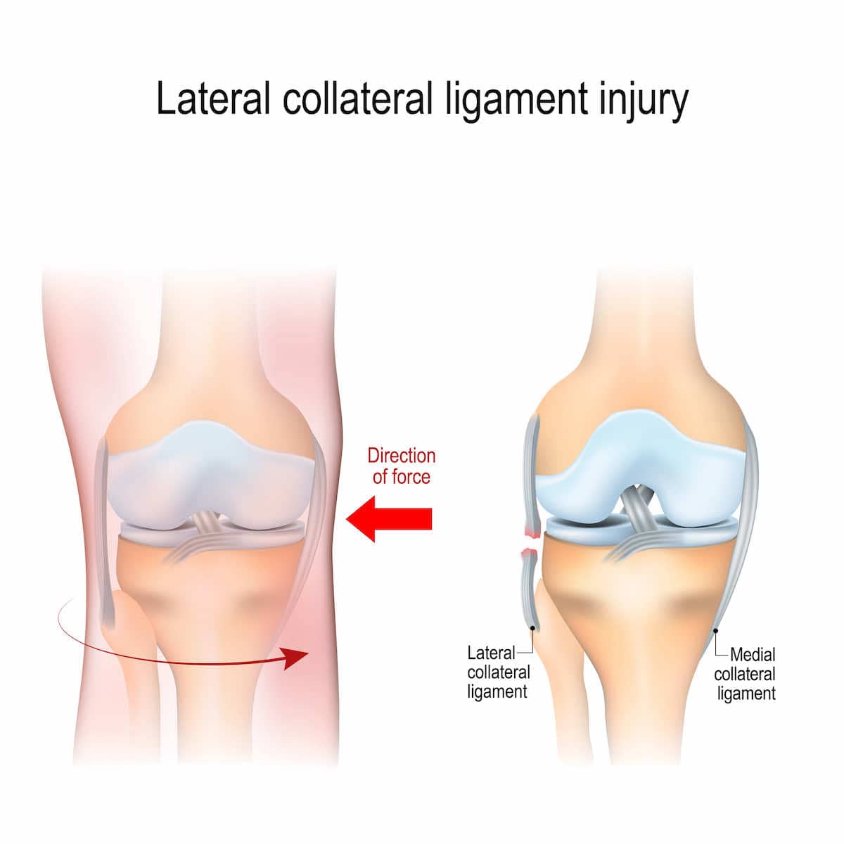 Lateral collateral ligament (LCL) injury