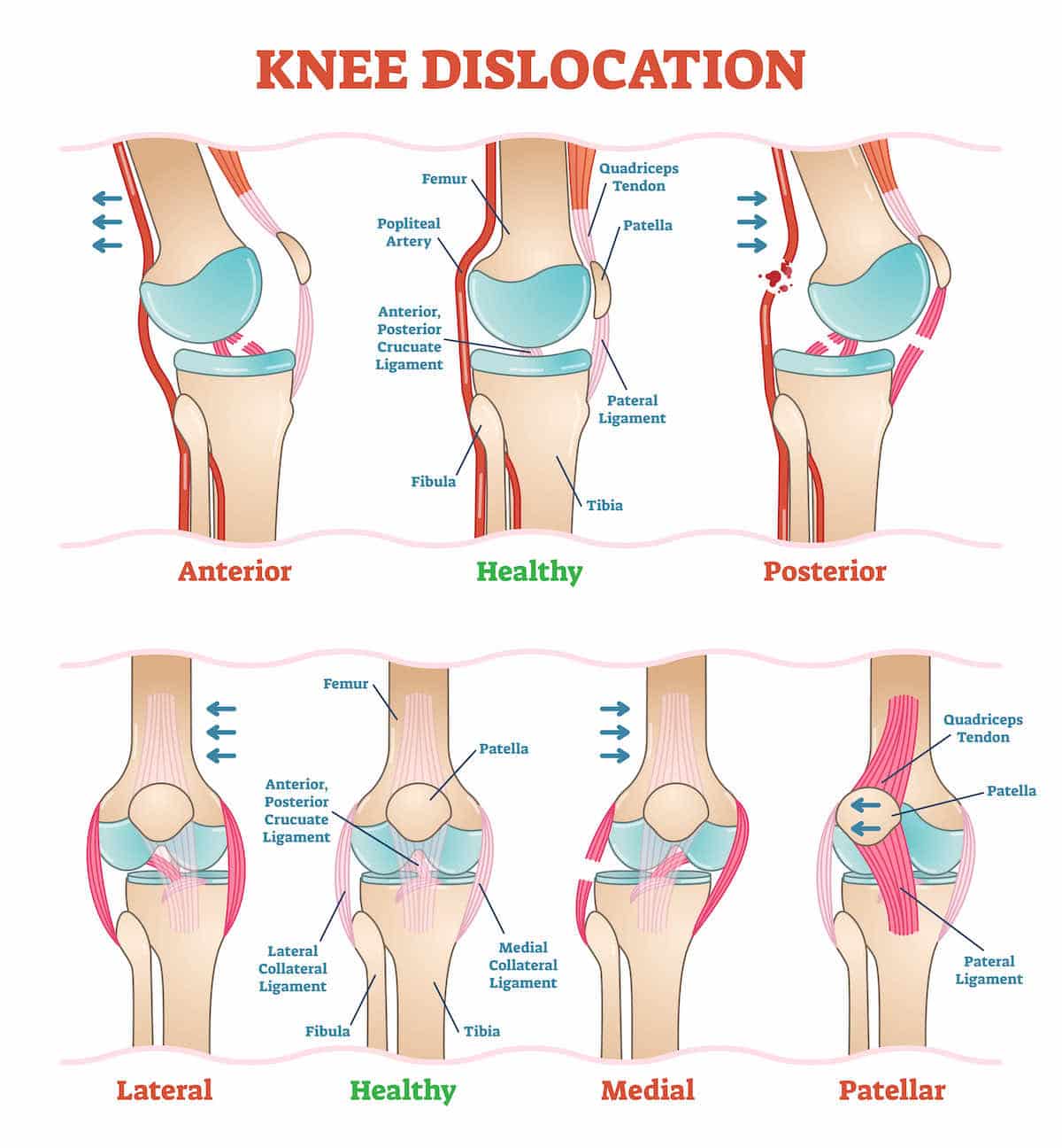 Prevention of Knee Dislocation