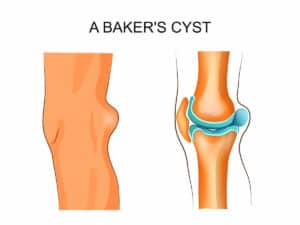 Baker's Cyst