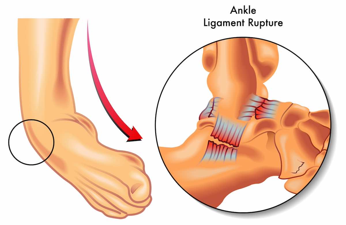 Ankle ligament tear