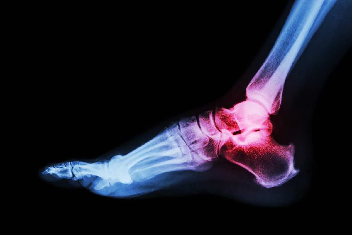 Foot arthritis exercises