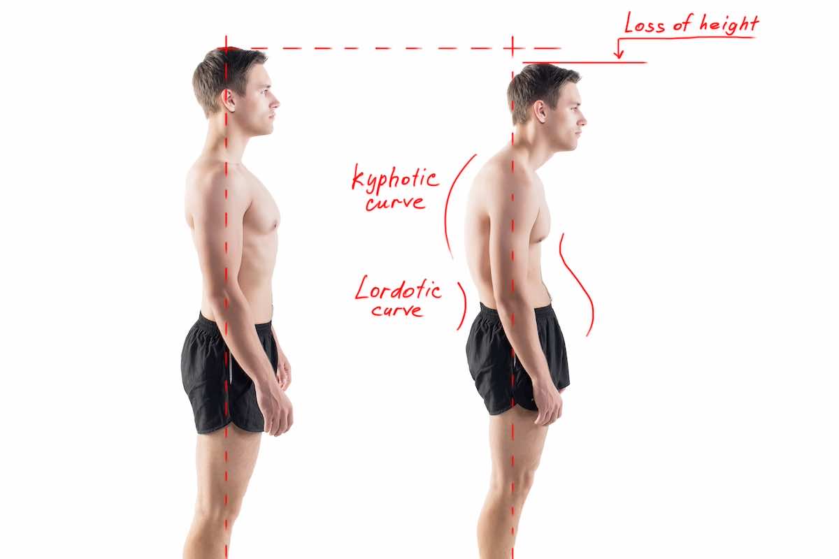 correcting poor posture with exercises