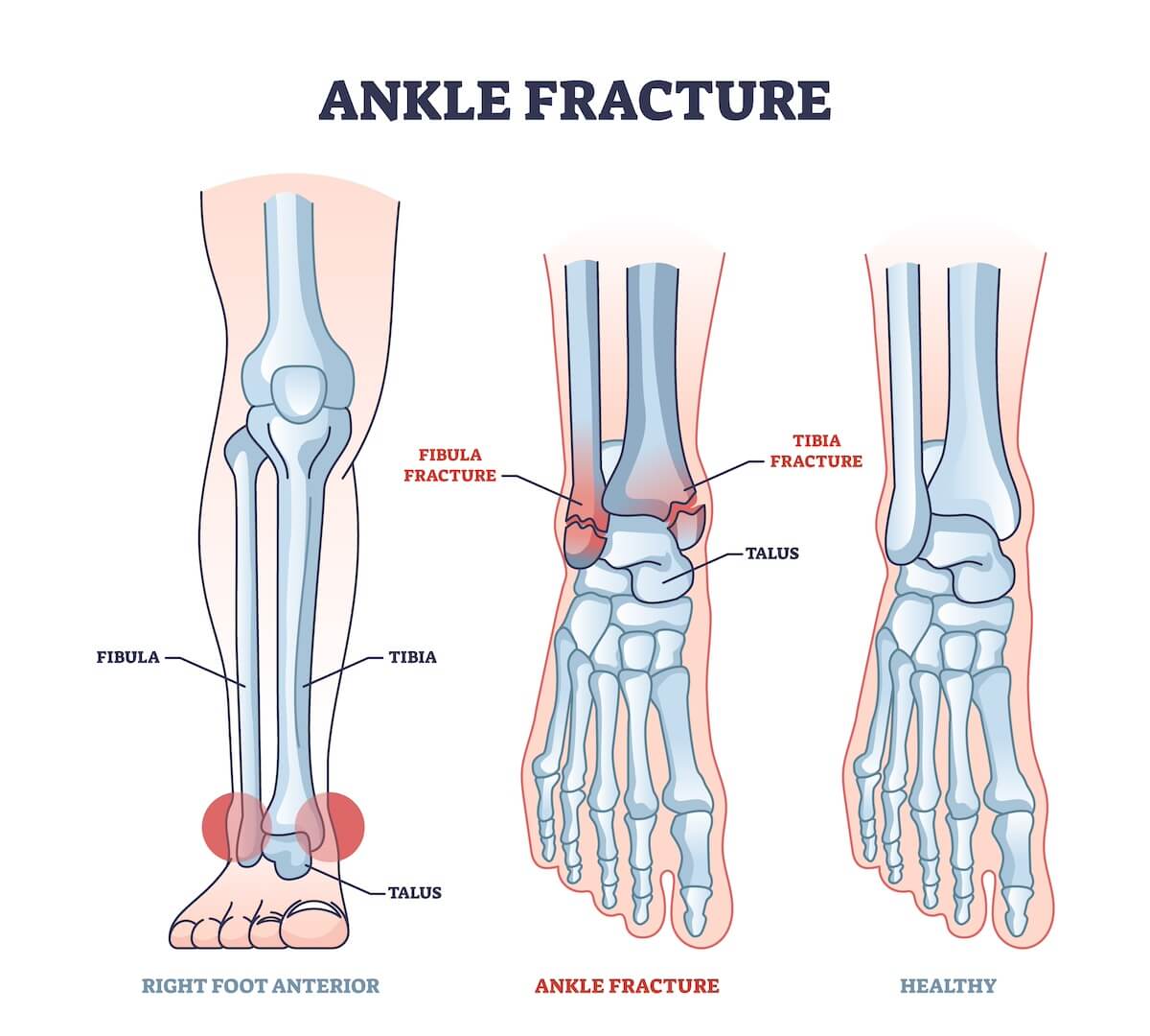 Exercises for Ankle fracture
