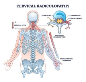 Cervical Radiculopathy Exercises