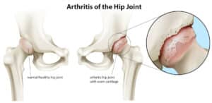 Hip arthritis exercises